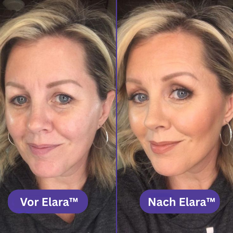 Elara™ Microneedling-Infusionsset