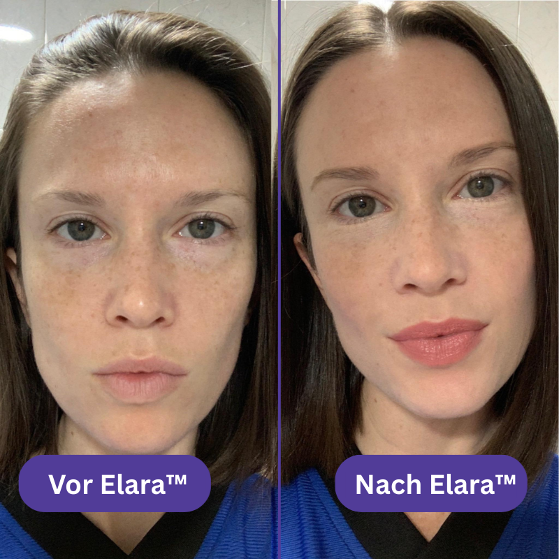 Elara™ Microneedling-Infusionsset